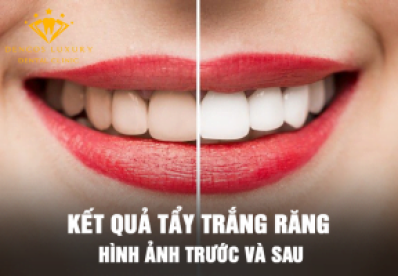 [Kết quả TẨY TRẮNG RĂNG] – Hình ảnh thực tế trước sau khi thực hiện