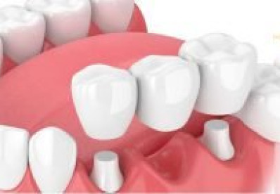 Hình ảnh cầu răng sứ cập nhật mới nhất năm từ khách hàng thực tế