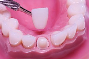 Bọc răng sứ có đau không? Bạn nên biết những điều này