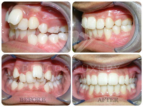 niềng răng trước và sau 