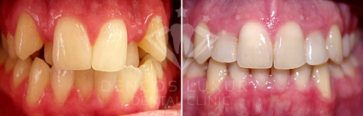 niềng răng trước và sau 1