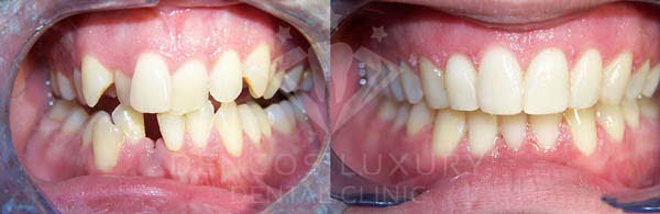 niềng răng trước và sau 2