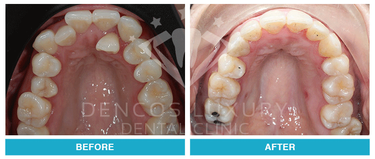 niềng răng trước và sau 5