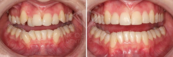 niềng răng trước và sau 6
