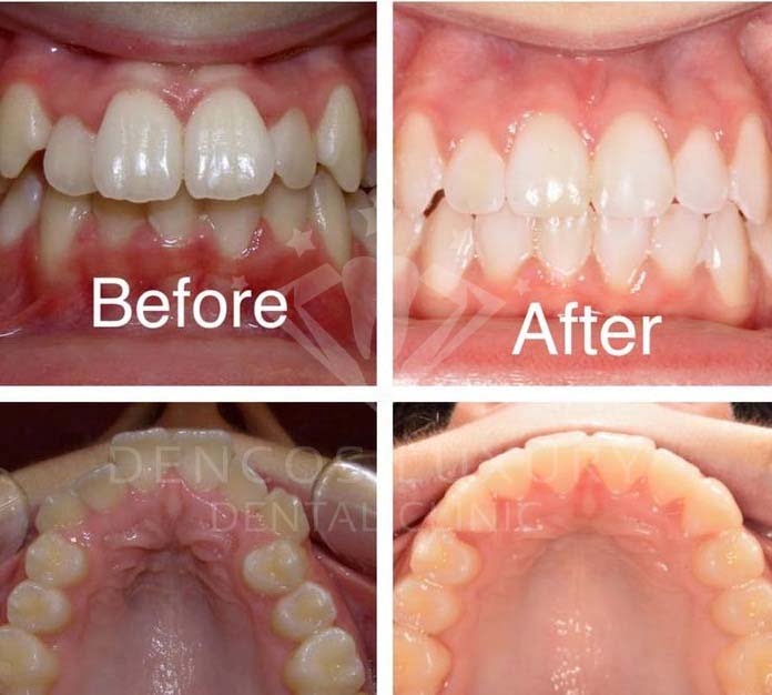 niềng răng trước và sau 7