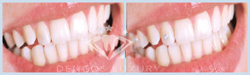 răng đính kim cương