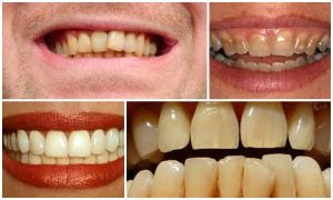 Tẩy trắng răng: Tẩy 1 lần, trắng sáng dài lâu