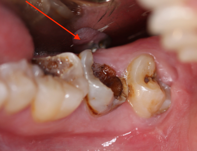 Vì sao dẫn đến bệnh viêm tủy răng?
