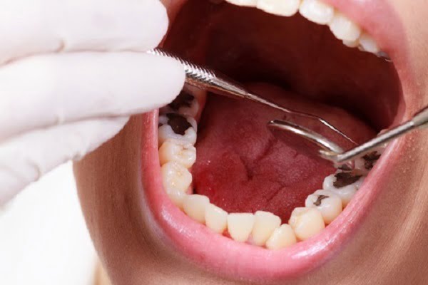 cách chữa sâu răng