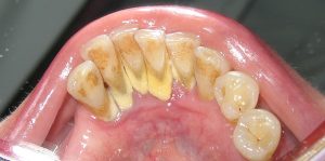 Quy trình lấy cao răng diễn ra như thế nào? < Xem quy trình chuẩn