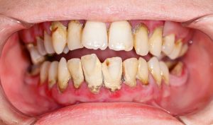 Có nên lấy cao răng thường xuyên không? Chia sẻ từ chuyên gia