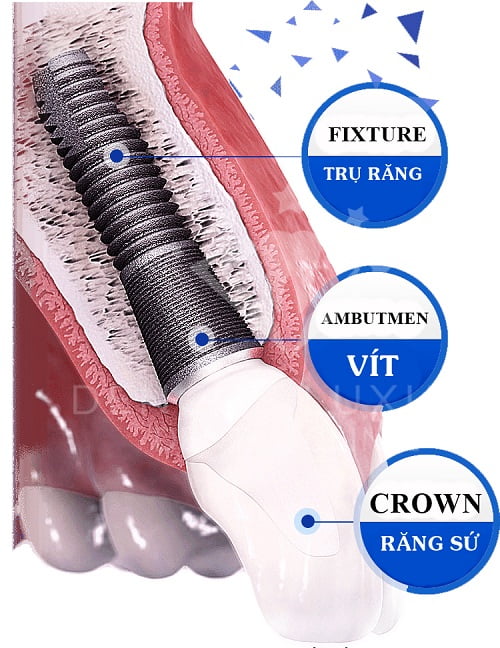 trong-rang-implant-o-dau-tot-3