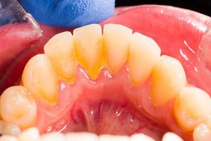 Lấy cao răng bằng dâu tây – Cách làm sạch răng hiệu quả 99%