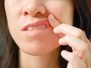 Bệnh lở miệng: Triệu chứng, Nguyên nhân và Giải pháp chữa dứt điểm