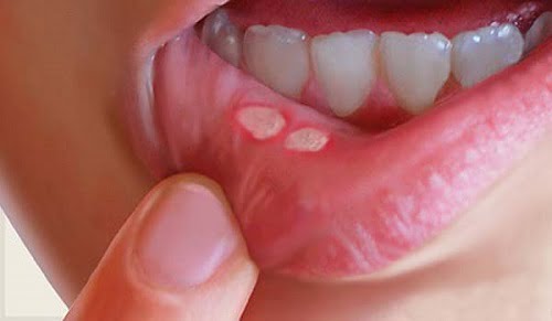 Bệnh lở miệng ở trẻ em | Nguyên nhân & 6 Cách chữa hiệu quả nhất 1