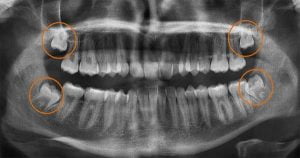 Nhổ răng số 8: Nguyên nhân, ảnh hưởng, chi phí nhổ răng số 8