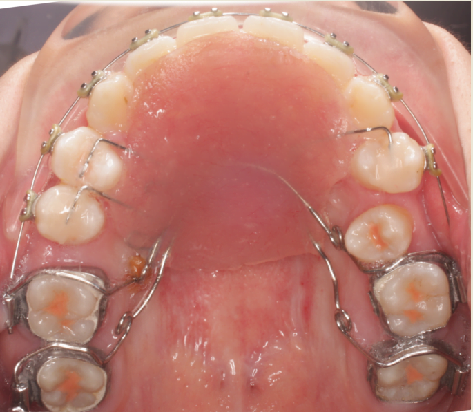 Nong hàm khi niềng răng