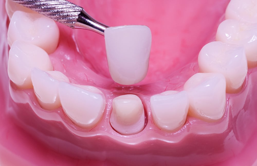 quy trình làm răng sứ thẩm mỹ 4