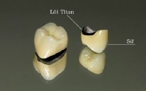 Bọc Răng sứ titan – Phục hình răng chắc khỏe, tiết kiệm chi phí