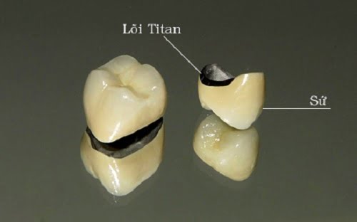 bọc răng sứ titan