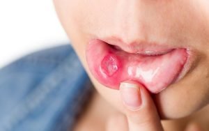 Những điều bạn chưa biết về bệnh lở miệng ở người lớn