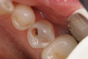 Nguyên nhân sâu răng và các phương pháp điều trị Hiệu Quả < Xem ngay