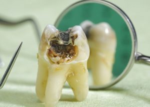 Nhổ răng sâu bao nhiêu tiền – Cẩn trọng nếu không muốn nguy hiểm đến sức khỏe