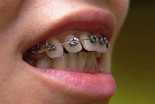 Niềng răng 1 hàm giá bao nhiêu?