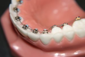 Niềng răng mặt trong giá bao nhiêu tiền? – Chi phí cho 1 liệu trình