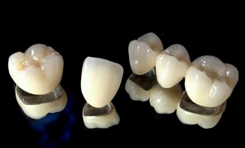 răng sứ titan có mấy loại