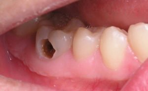 Sâu răng kiêng ăn gì? Nếu bạn muốn khỏi bệnh hãy đọc ngay!
