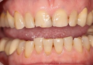 Thiểu sản men răng: Nguyên nhân và cách điều trị triệt để