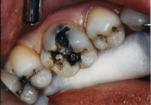 Bệnh viêm tủy răng có nguy hiểm không? Nên chữa ở đâu?