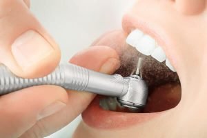 Mài răng nanh nhọn nên cẩn trọng điều gì?