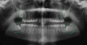 Tư vấn cùng chuyên gia: Mọc răng khôn trong bao lâu?