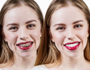 Niềng răng có làm thay đổi khuôn mặt? – Sự thật khiến bạn bất ngờ