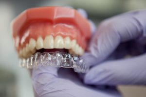 Niềng răng invisalign có tốt không? – Chuyên gia giải đáp cho bạn