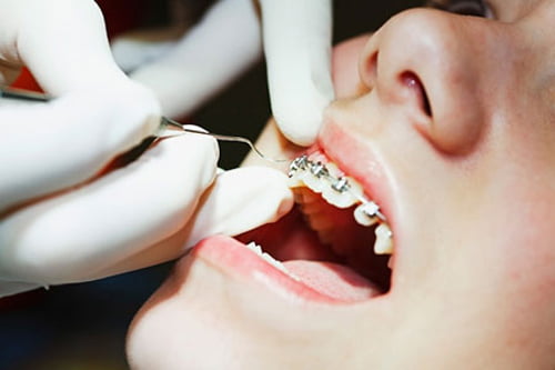 bác sĩ điều chỉnh mắc cài niềng răng cho bệnh nhân