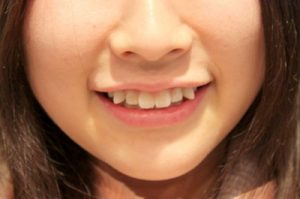 Những thông tin thú vị xung quanh chiếc răng khểnh