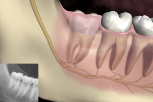 Sưng lợi mọc răng khôn uống thuốc gì để giảm đau và giảm sưng “thần tốc”?