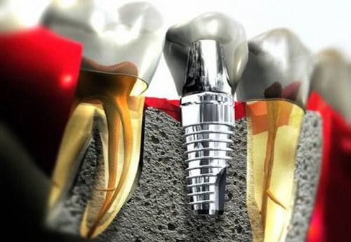 công nghệ trồng răng implant