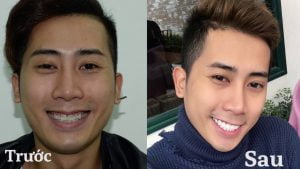 MC Vương Duy Khánh chia sẻ về tình trạng bọc răng sứ sau 1 năm