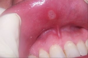 Nguyên nhân bị nhiệt miệng thường xuyên & cách chữa trị triệt để 1