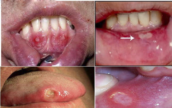 Nhiệt miệng là gì - Nguyên nhân & cách chữa hiệu quả "CẤP TỐC" 3