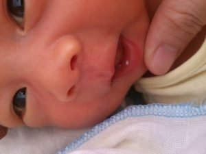 Trẻ sơ sinh bị nhiệt miệng – Tổng hợp kiến thức cha mẹ cần biết