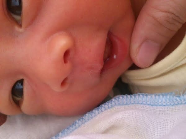 Trẻ sơ sinh bị nhiệt miệng - Nguyên nhân & cách điều trị AN TOÀN nhất 1