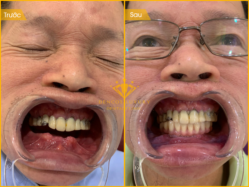 trồng răng implant toàn hàm