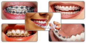 Các loại mắc cài niềng răng hiện nay | Nha khoa thẩm mỹ