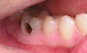Sâu răng có lây không – Lý giải từ chuyên gia nha khoa