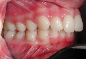 Hô hàm có niềng răng được không? – Lý giải từ chuyên gia